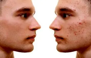 نکاتی که باید درباره جوش‌های صورت بدانید | این جوش ها را فشار ندهید