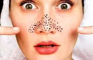 راهکاری برای از بین بردن جوش‌های سر سیاه صورت + ویدئو