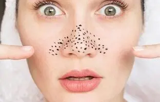 راهکاری برای از بین بردن جوش‌های سر سیاه صورت + ویدئو