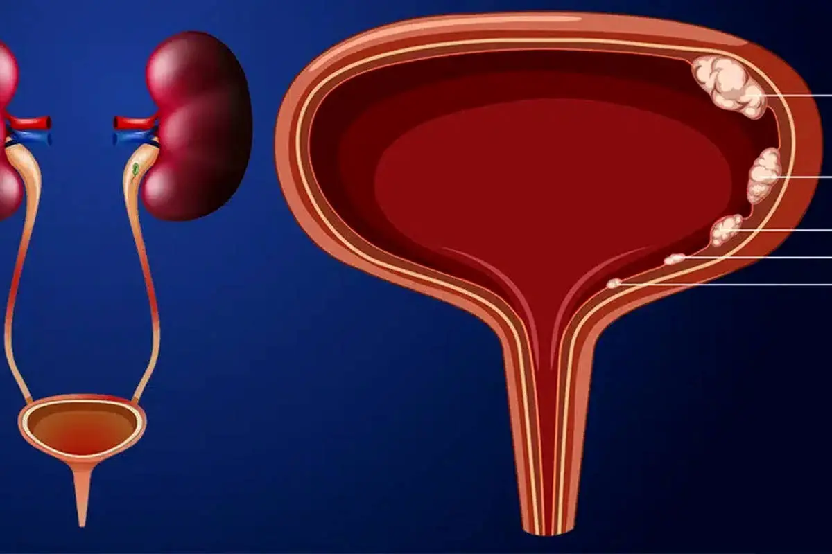 شایع‌ترین علامت سرطان مثانه که سیگاری‌ها باید جدی بگیرند 