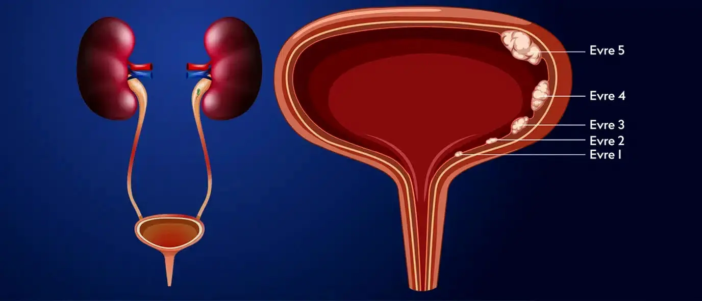 شایع‌ترین علامت سرطان مثانه که سیگاری‌ها باید جدی بگیرند 