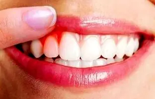 چه عواملی باعث ایجاد بیماری لثه می‌شوند؟