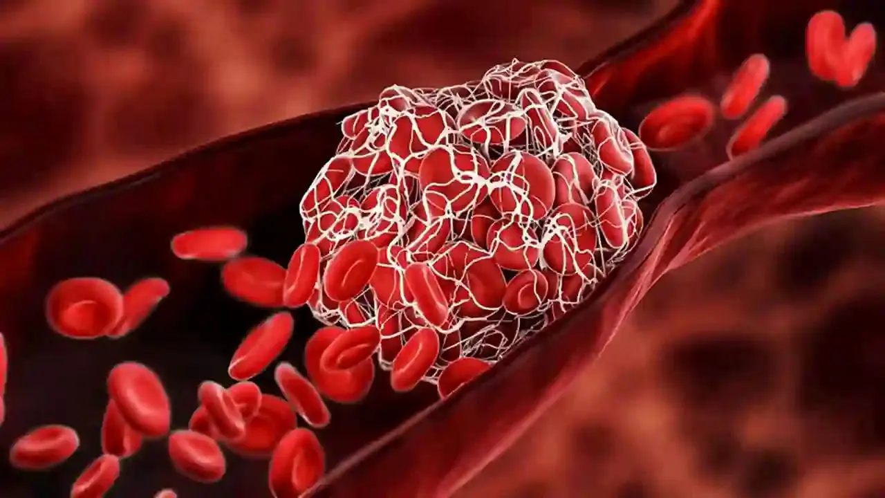 این درد، از علائم لخته شدن خون در بدن است