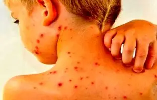 با این واکسن سرخک را تار و مار کنید