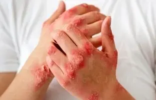 بیماری پسوریازیس چیست؟