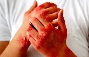 بیماری پسوریازیس چیست؟