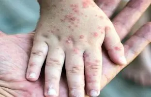 چه کسانی برای اربعین باید واکسن سرخک بزنند؟