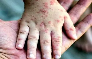 چه کسانی برای اربعین باید واکسن سرخک بزنند؟