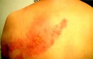 (ویدئو) درد بعد از ابتلا به زونا را چگونه کم کنیم؟