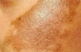 روشهای جلوگیری از لک‌های پوستی در بارداری
