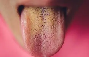 علت زرد بودن زبان