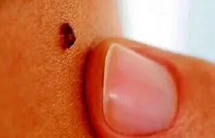 خال سرطانی را چطور می‌توان تشخیص داد؟