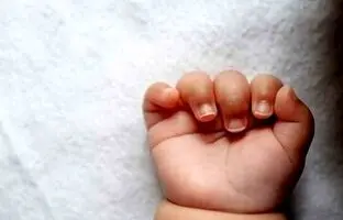 تولد اولین نوزاد انسان با روش Fertilo