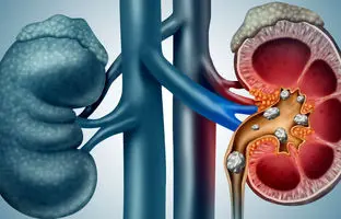 درمان سنگ کلیه در طب سنتی؛ کدام داروهای گیاهی موثرند؟