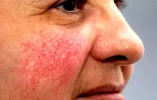  درمان خانگی واریس صورت (۶ روش موثر و آسان)