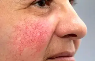  درمان خانگی واریس صورت (۶ روش موثر و آسان)