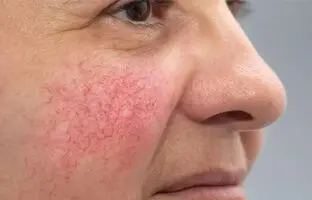  درمان خانگی واریس صورت (۶ روش موثر و آسان)