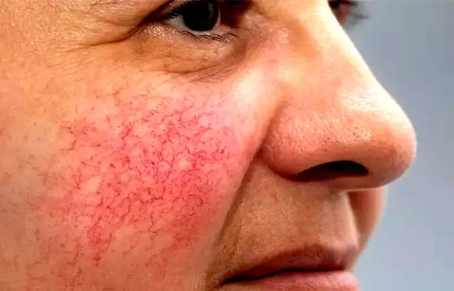  درمان خانگی واریس صورت (۶ روش موثر و آسان)