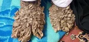 تصاویر دلخراش از مرد درختی ایران که وایرال شد/ بیماری او چیست؟