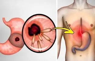  چه عواملی باعث سوزش سر دل می‌شوند؟ 