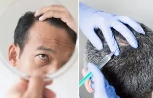 روشی برای فرار از طاسی؛ «بوتاکس جدید» با ریزش مو مقابله می‌کند