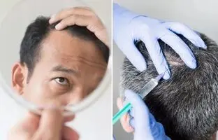 روشی برای فرار از طاسی؛ «بوتاکس جدید» با ریزش مو مقابله می‌کند