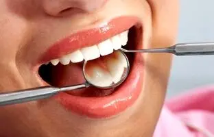 ۷ روش خانگی برای پاک کردن لکه های قهوه ای روی دندان