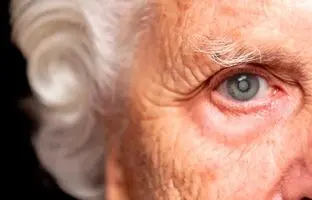  علل بالا رفتن ناگهانی نمره چشم + ویدئو