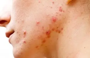 نکته مهم برای درمان جوش در خانم‌ها + ویدئو