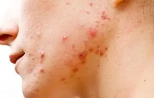 نکته مهم برای درمان جوش در خانم‌ها + ویدئو