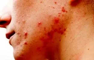 نکته مهم برای درمان جوش در خانم‌ها + ویدئو