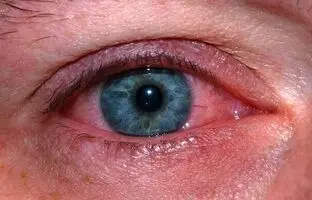 «برف کوری» چیست و چگونه از آن پیشگیری کنیم؟
