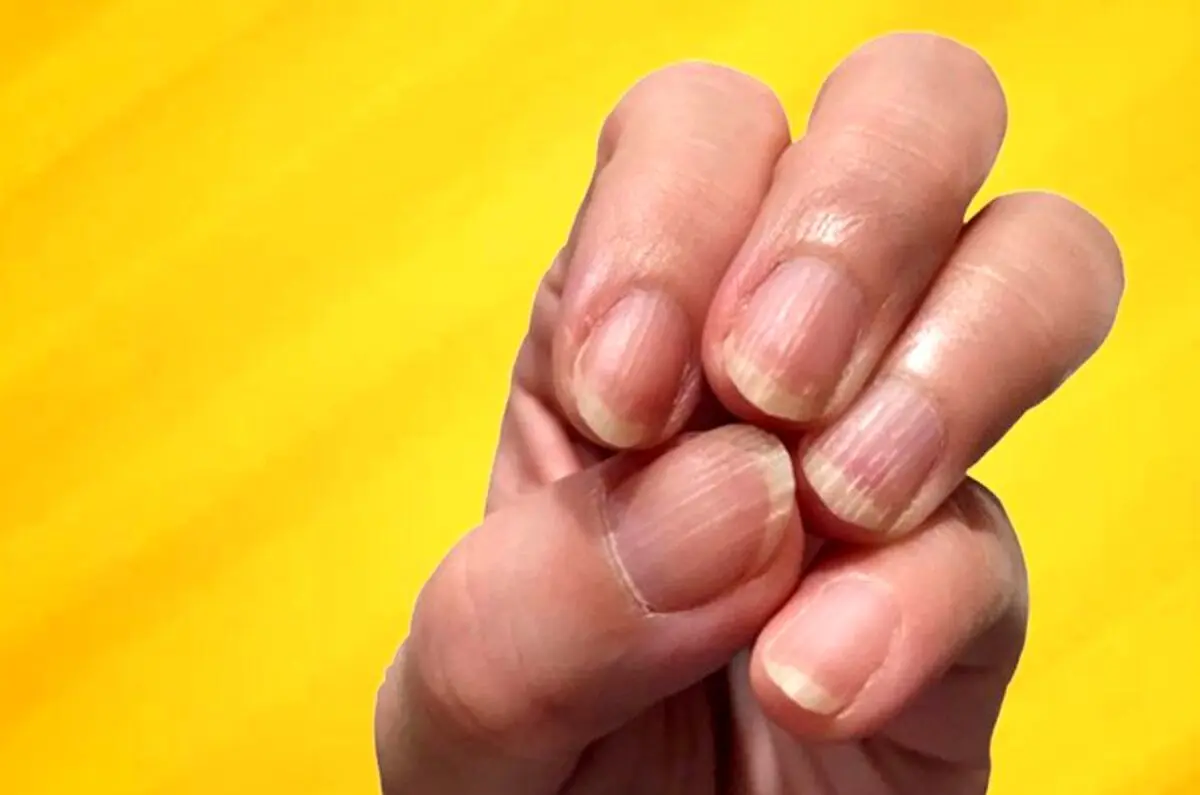 خطوط عمودی یا افقی روی ناخن‌ها علامت چیست؟