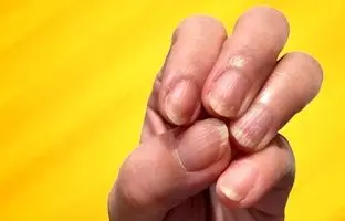 خطوط عمودی یا افقی روی ناخن‌ها علامت چیست؟