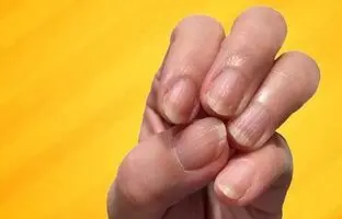 خطوط عمودی یا افقی روی ناخن‌ها علامت چیست؟