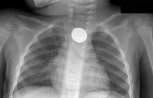 توصیه‌ها برای نجات کودکانی که باتری دکمه‌ای بلعیده‌اند!