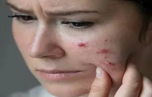 جوش‌های صورت چگونه زندگی را تهدید می‌کنند؟