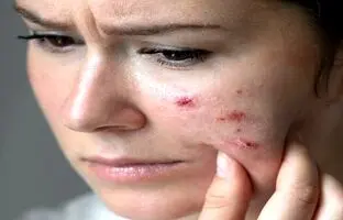جوش‌های صورت چگونه زندگی را تهدید می‌کنند؟