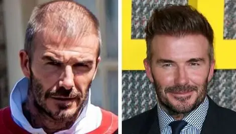 ستارگان فوتبال جهان که ریزش مو را با کاشت مو متوقف کردند؛ از صلاح تا بکام + عکس