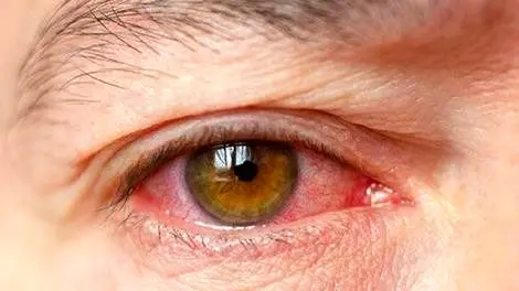 چه غذاهایی فشار چشم را بالا میبرد؟