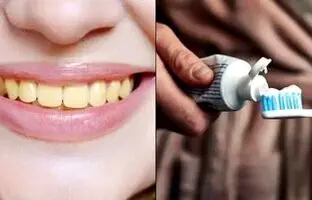 چرا دندان‌ ها زشت می‌ شود؟