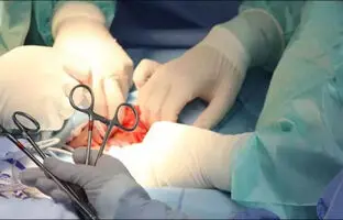  جراحی برای سنگ‌کلیه؛ آری یا خیر؟ + ویدئو