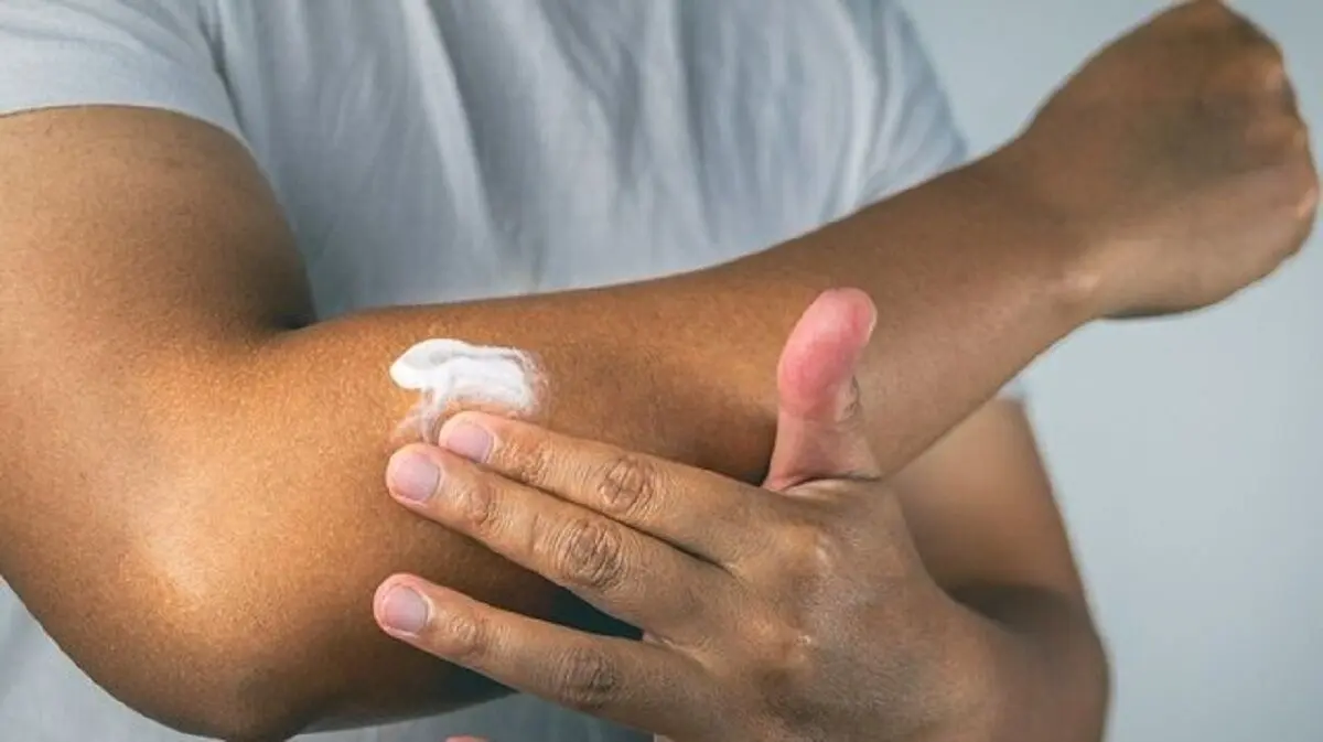آیا افراد با پوست تیره هم به ضد آفتاب نیاز دارند؟
