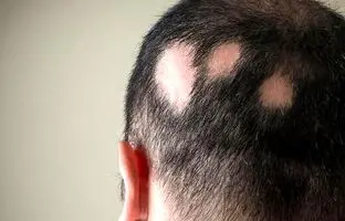 ریزش سکه‌ ای مو را متوقف کنید: راهکار های موثر و علمی + ویدئو
