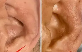 چین‌خوردگی‌های لاله گوش، خبر از یک بیماری مهم می‌دهد/ عکس