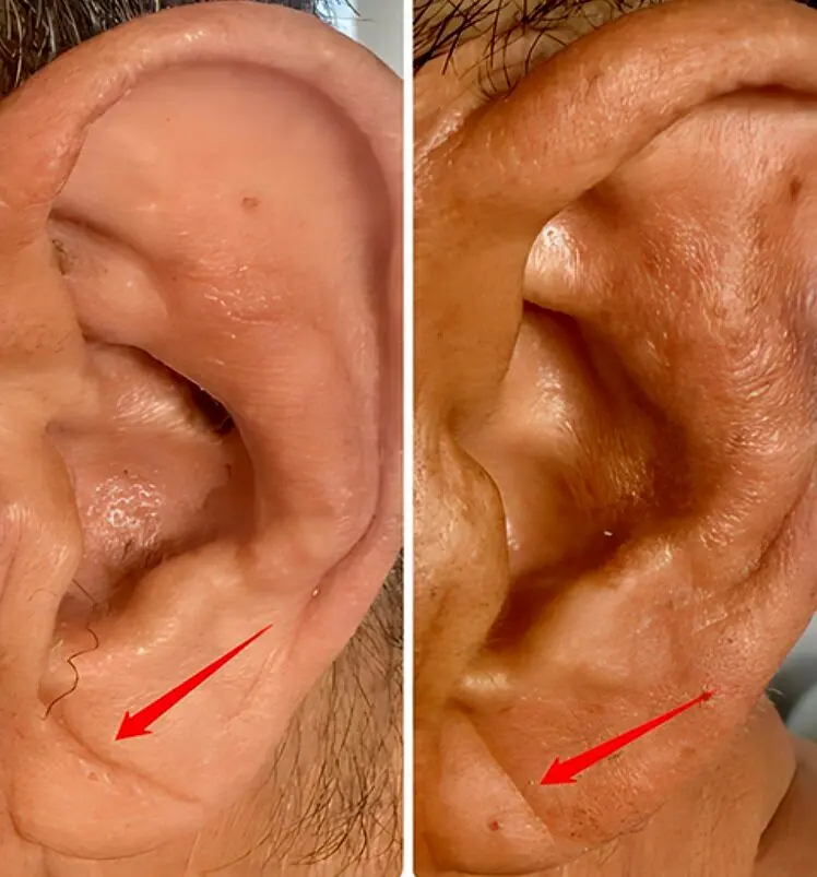 چین‌خوردگی‌های لاله گوش، خبر از یک بیماری مهم می‌دهد/ عکس