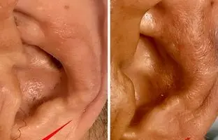 چین‌خوردگی‌های لاله گوش، خبر از یک بیماری مهم می‌دهد/ عکس