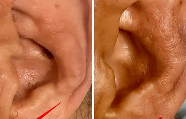 چین‌خوردگی‌های لاله گوش، خبر از یک بیماری مهم می‌دهد/ عکس