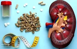 ساده ترین راه برای جلوگیری از سنگ کلیه ؛ این علائم مهم را بشناسید