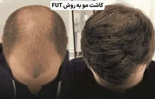 کاشت مو چند روش دارد؟ راهنمای انتخاب بهترین روش برای شما